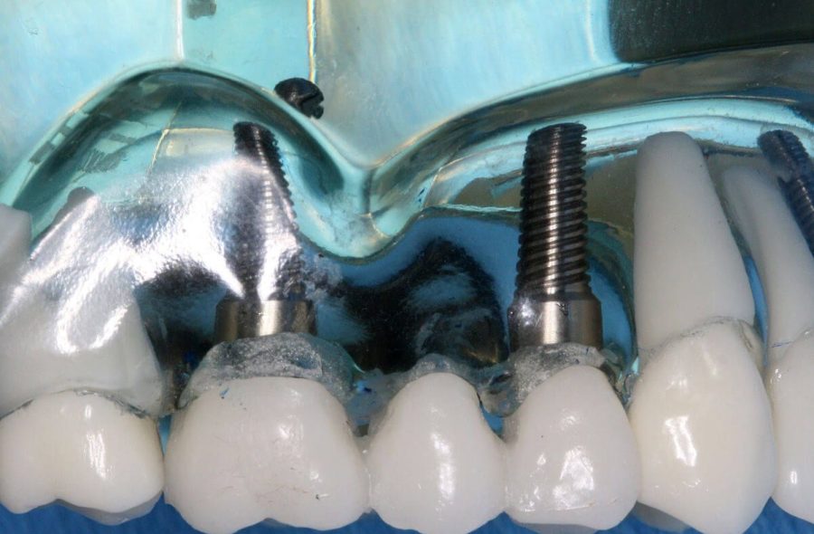 L’implant dentaire 3D pour reconstituer une vraie dent